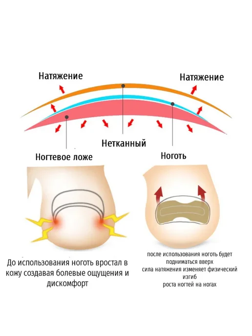 kani-ali Наклейка для коррекции вросших ногтей на ногах, бежевый, фото 5