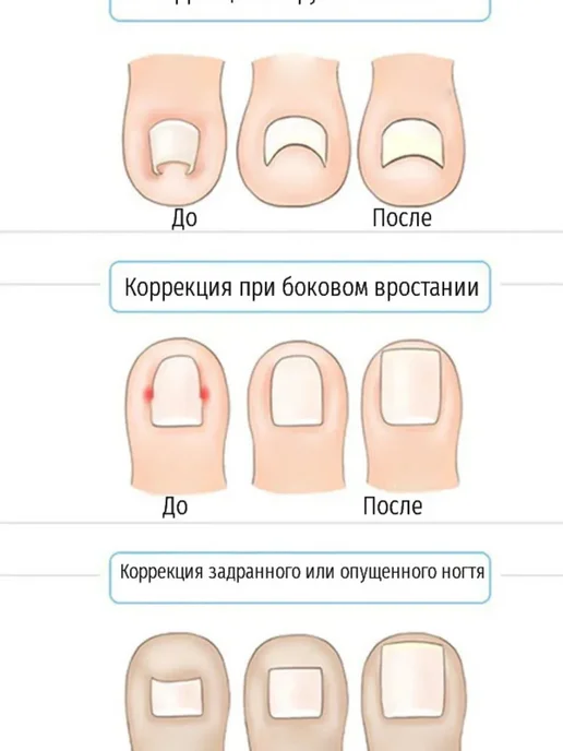 kani-ali Наклейка для коррекции вросших ногтей на ногах, бежевый, фото 7